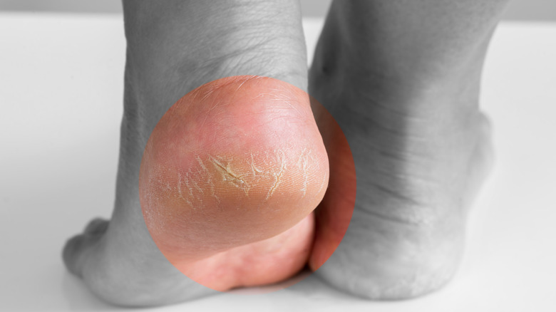 Black and white image of cracked heel