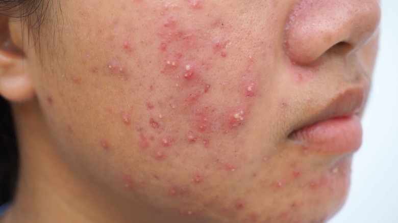 infected pimples on cheek