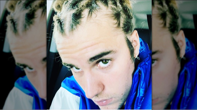 Justin Bieber with older hairstyle that shows hair thinning areas.