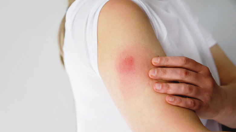 Rash on woman's upper arm