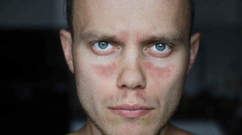 Man with red face rash