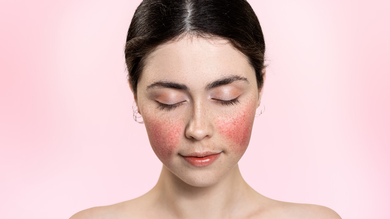 Woman with butterfly face rash
