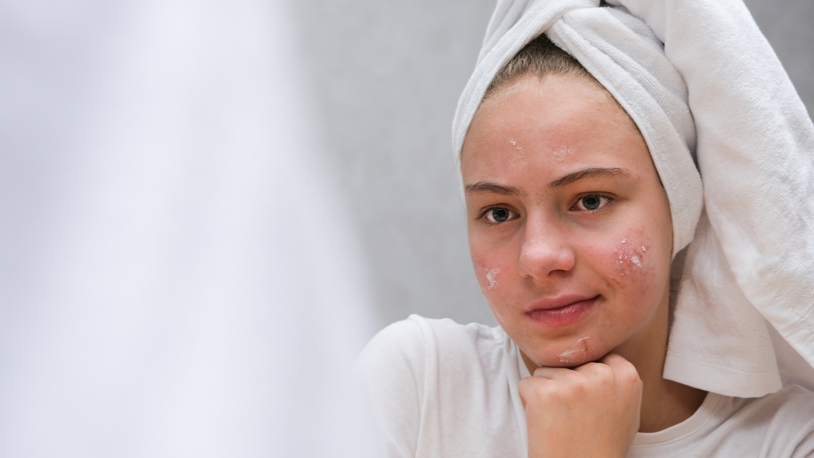 Does Accutane Permanently Get Rid Of Acne?