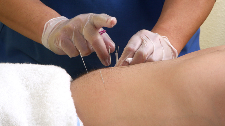 acupuncture needles on male stomach