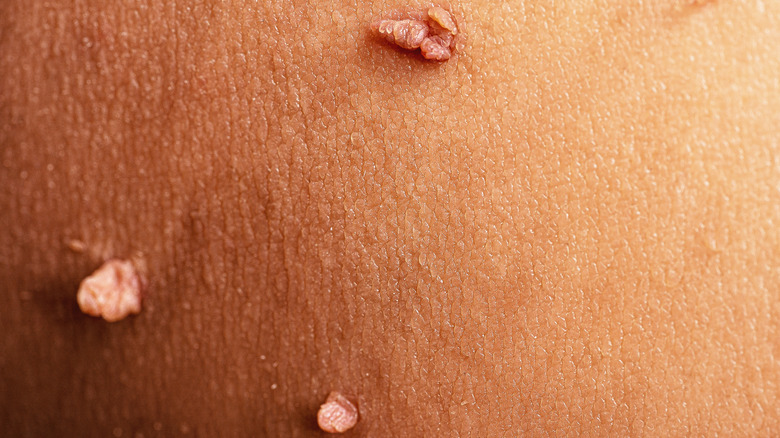 skin tags