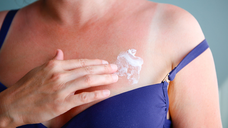 Applying moisturizer to sunburn