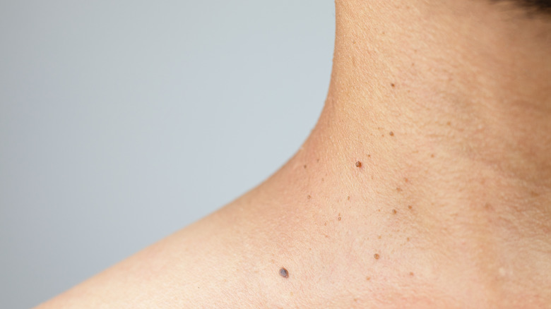 skin tags on body