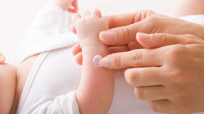 baby eczema on hand