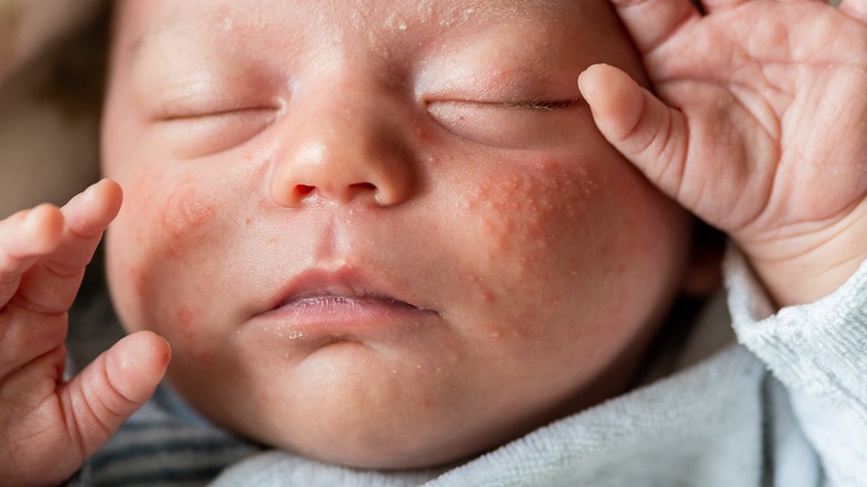baby acne on face