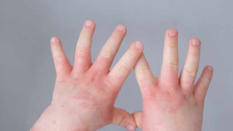 baby eczema on hands
