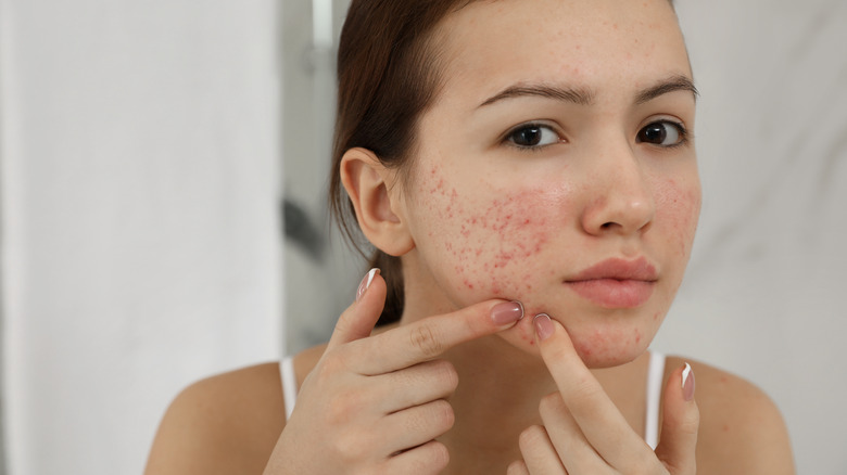 A woman looks at her acne