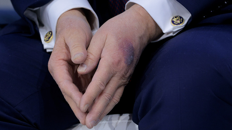 Close-up of Trump's bruised hands