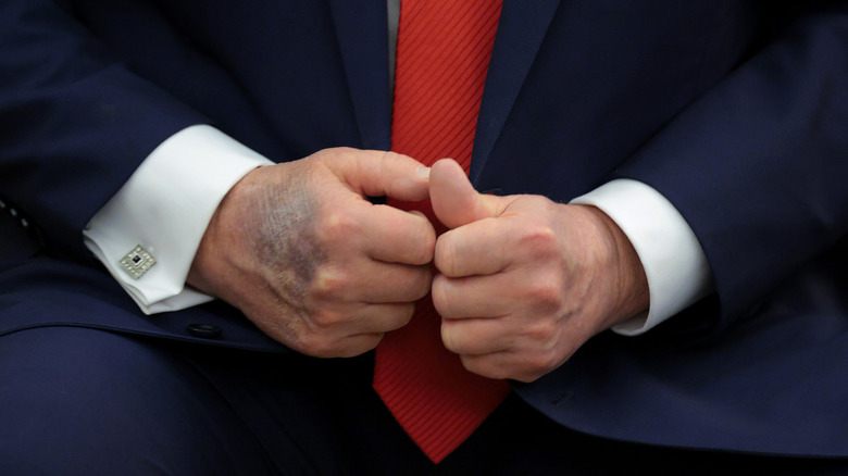 Close up on President Donald Trump's hands, he wears a suit and a large bruise appears on his right hand.