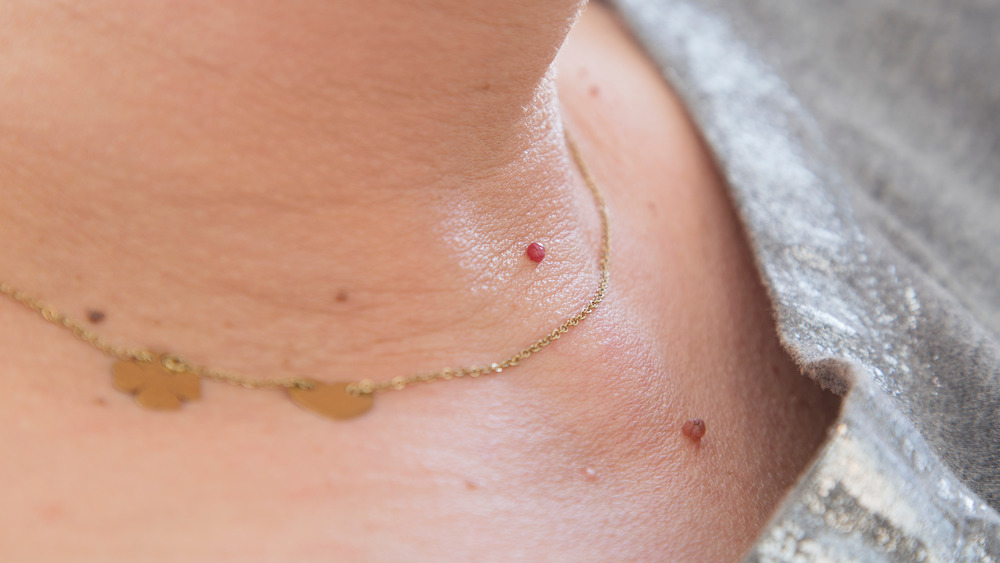 Close up of skin tags on person's neck