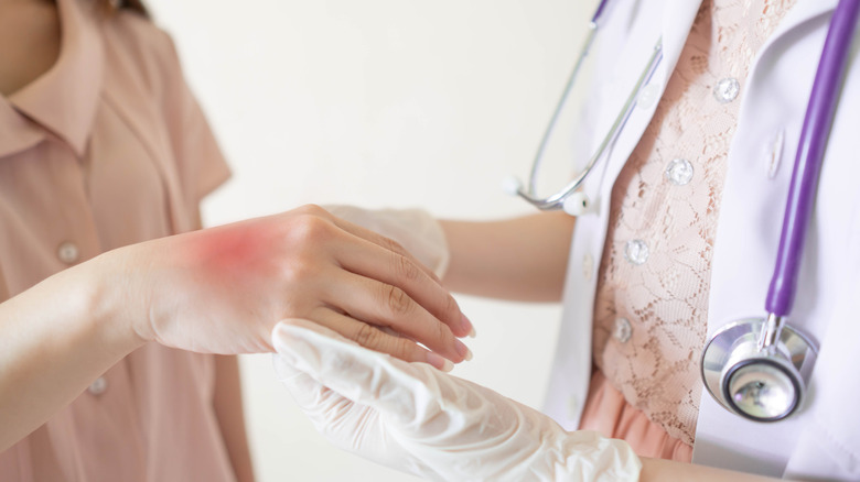 Doctor looking at eczema on patient's hand