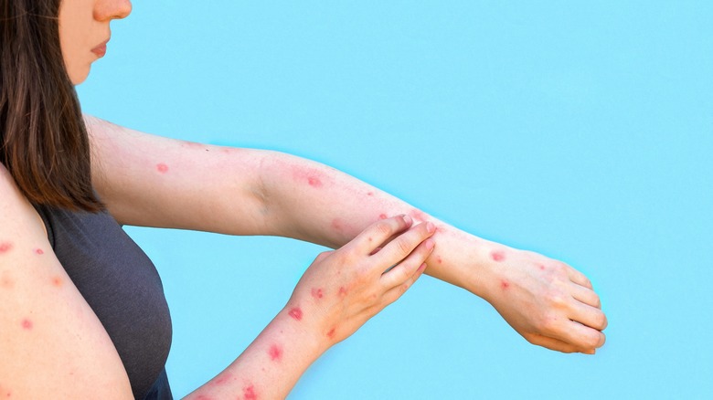 Woman with monkeypox touching a rash on her arm