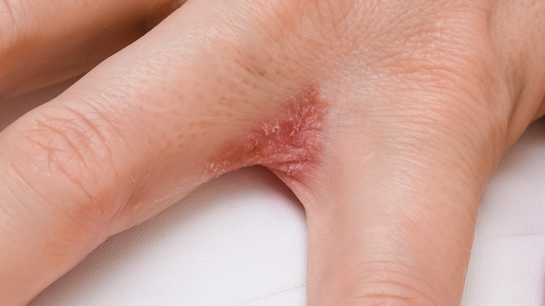 dyshidrotic eczema between fingers