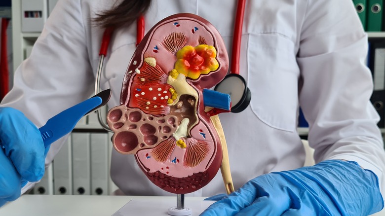 Model of kidney with cysts