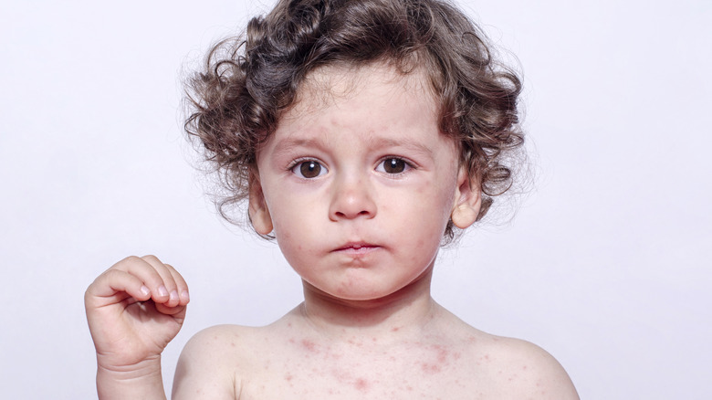 Young boy with rubella