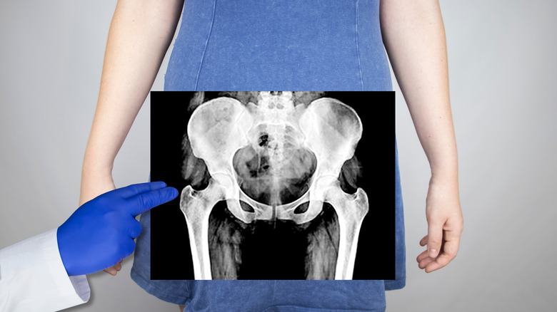 x-ray of woman's pelvis