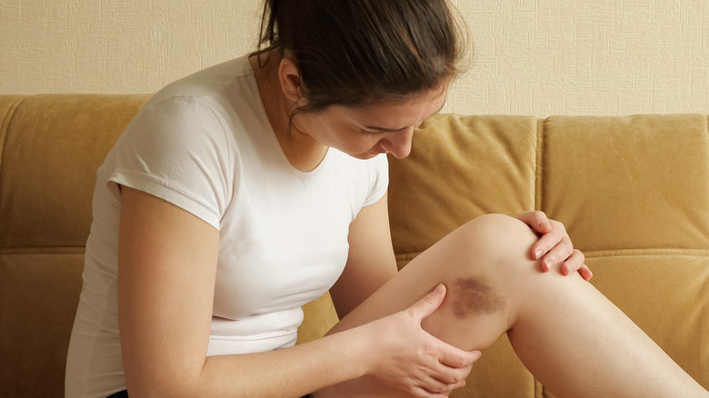 Woman sits down and examines a bruise on her leg