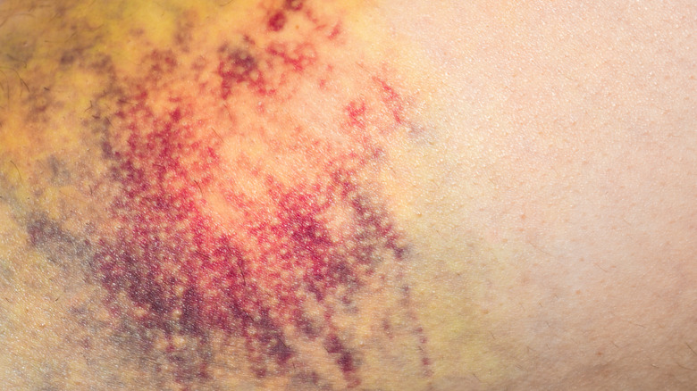 A close up picture of a bruise