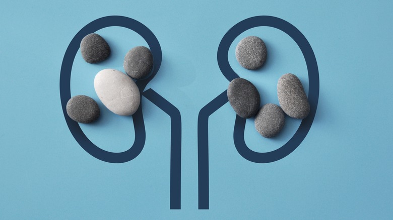 Drawn kidneys with stones