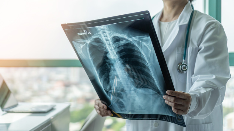 doctor holding an X-ray of a rib cage 