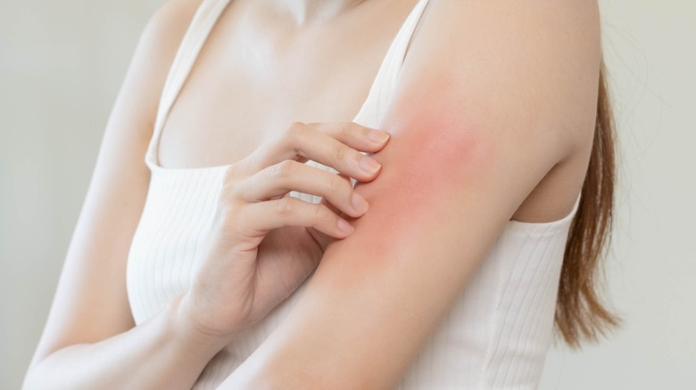 woman with eczema on arm