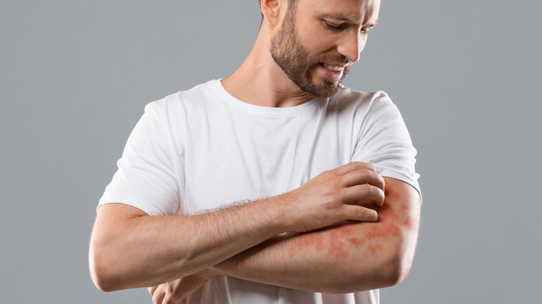 Man with psoriasis scratching his arm 