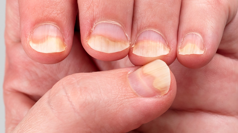 Close-up of brittle nails