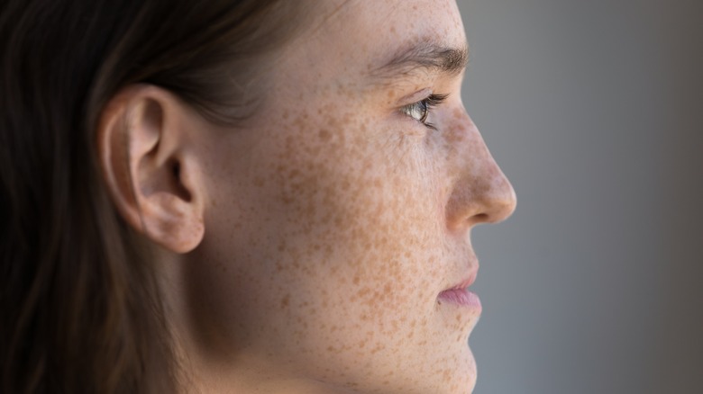Girl with lots of freckles on face