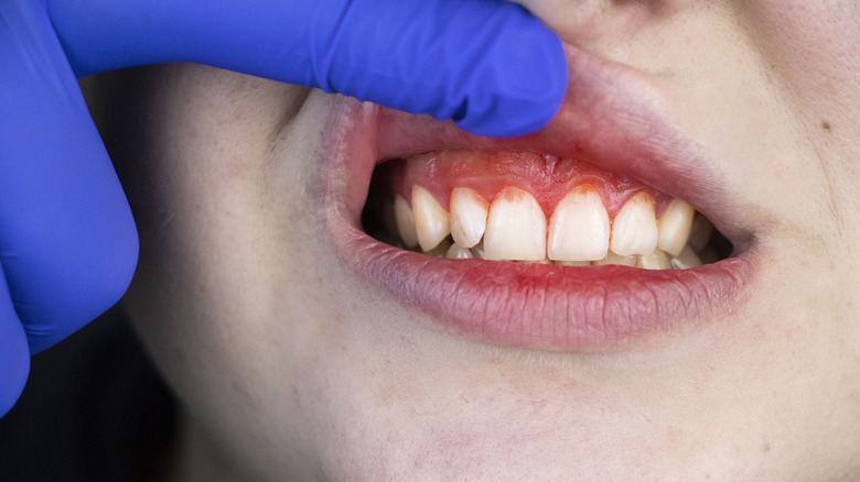 Person with swollen gums