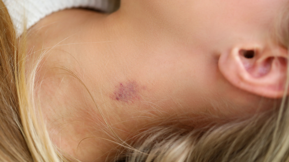 close up of woman's neck with hickey