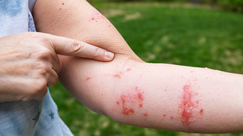 Poison ivy rash