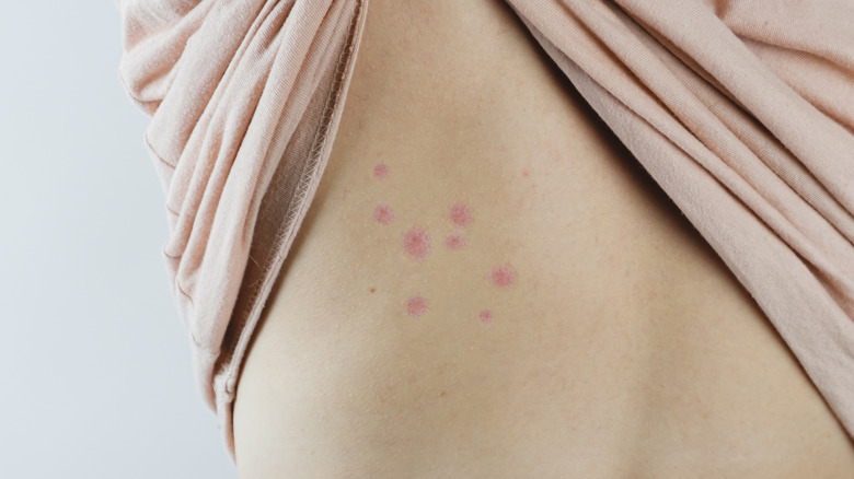 Bed bug bites on someone's back
