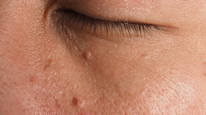 Mole under woman's eye