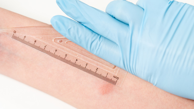 A gloved hand holds a ruler against a TB test reaction on patient's arm