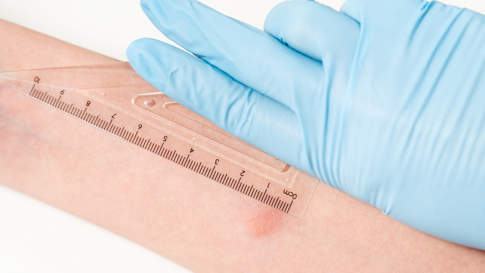 Tb Testing Picture Here's What To Expect From A TB Test