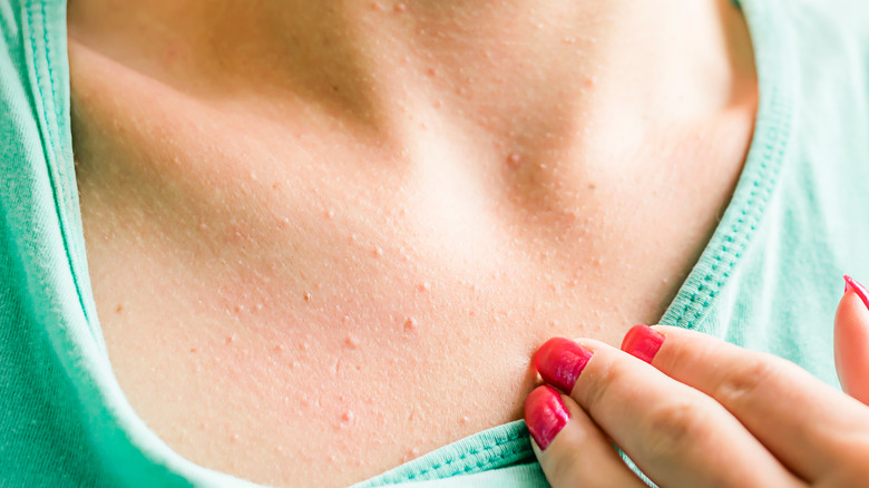 A woman has acne on her chest