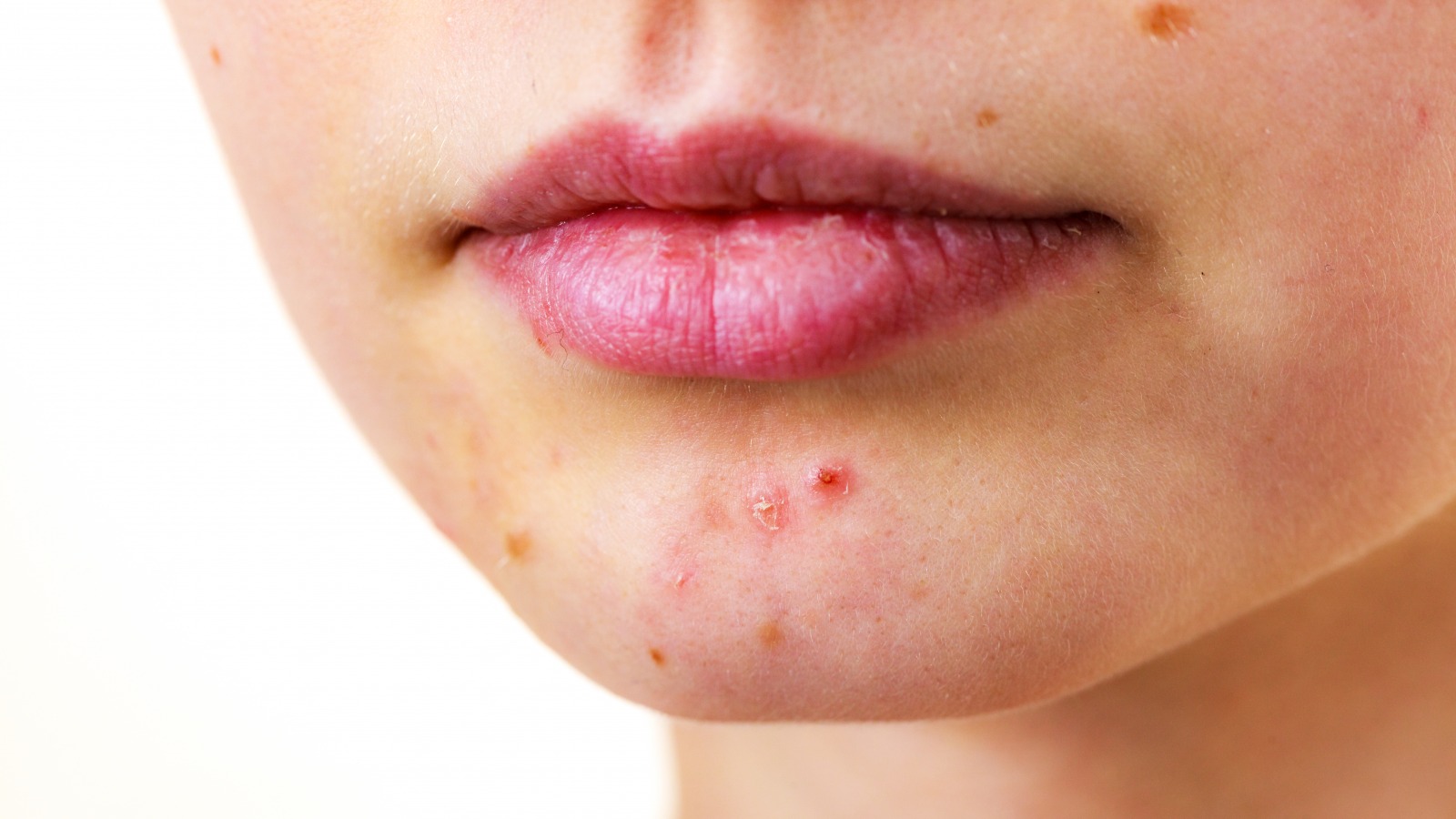 Chin acne shop