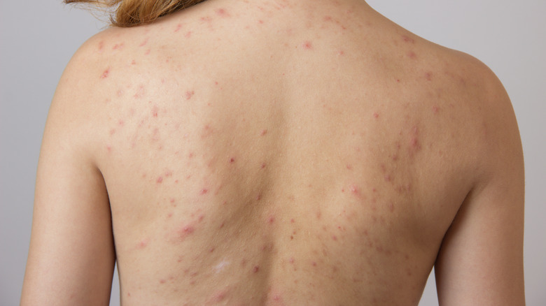 woman with back acne