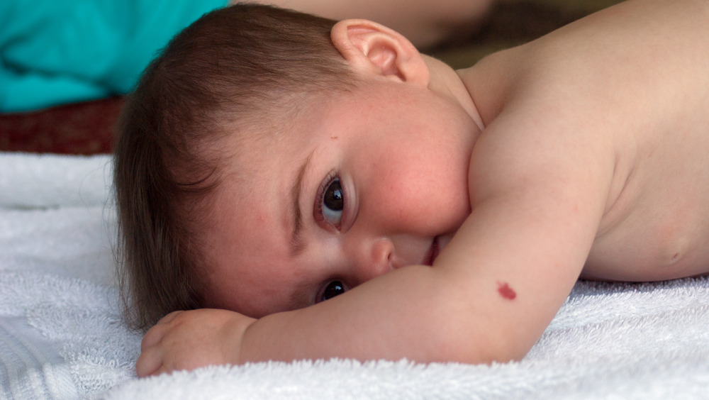 Baby with birthmark on arm