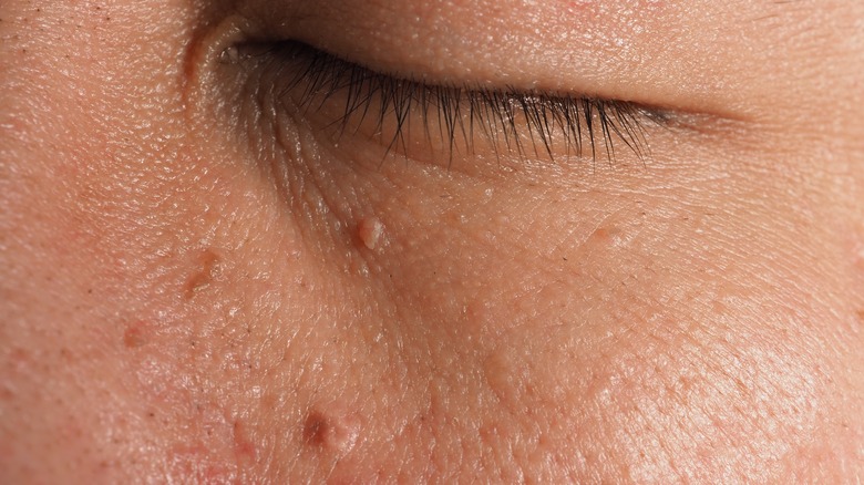 Skin tags on person