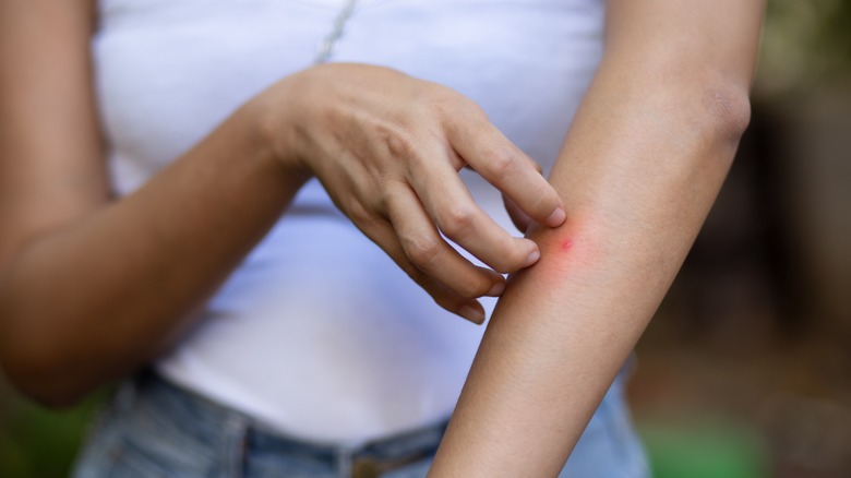woman itching mosquito bite