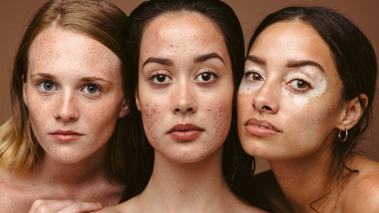 Three women suffering from various skin conditions, including acne