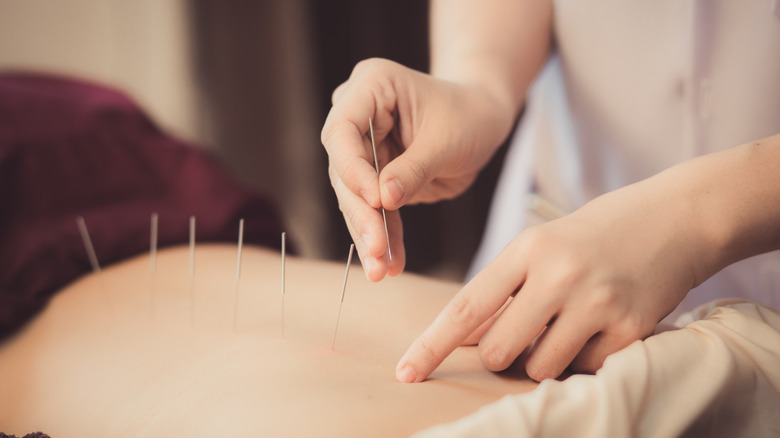acupuncture on lower back