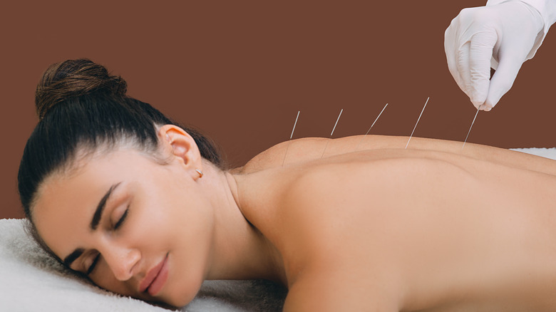 a woman lies on a table with her eyes closed as a gloved practitioner applies acupuncture needles