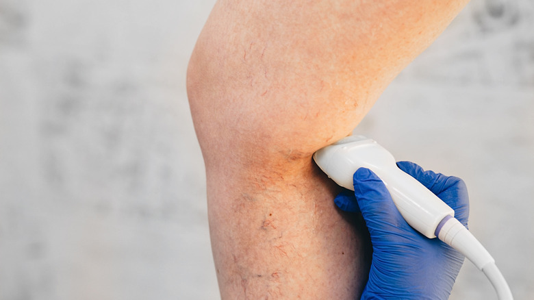 Doctor checking patient's varicose veins