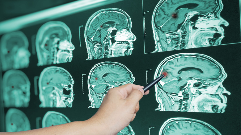 a doctor reviewing brain scans